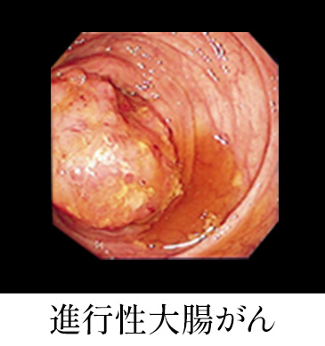 進行性大腸がんの画像