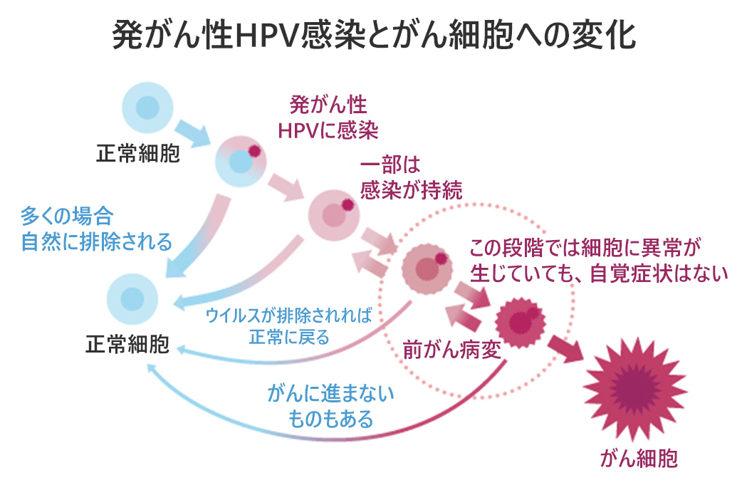 発がん性HPV感染とがん細胞への変化